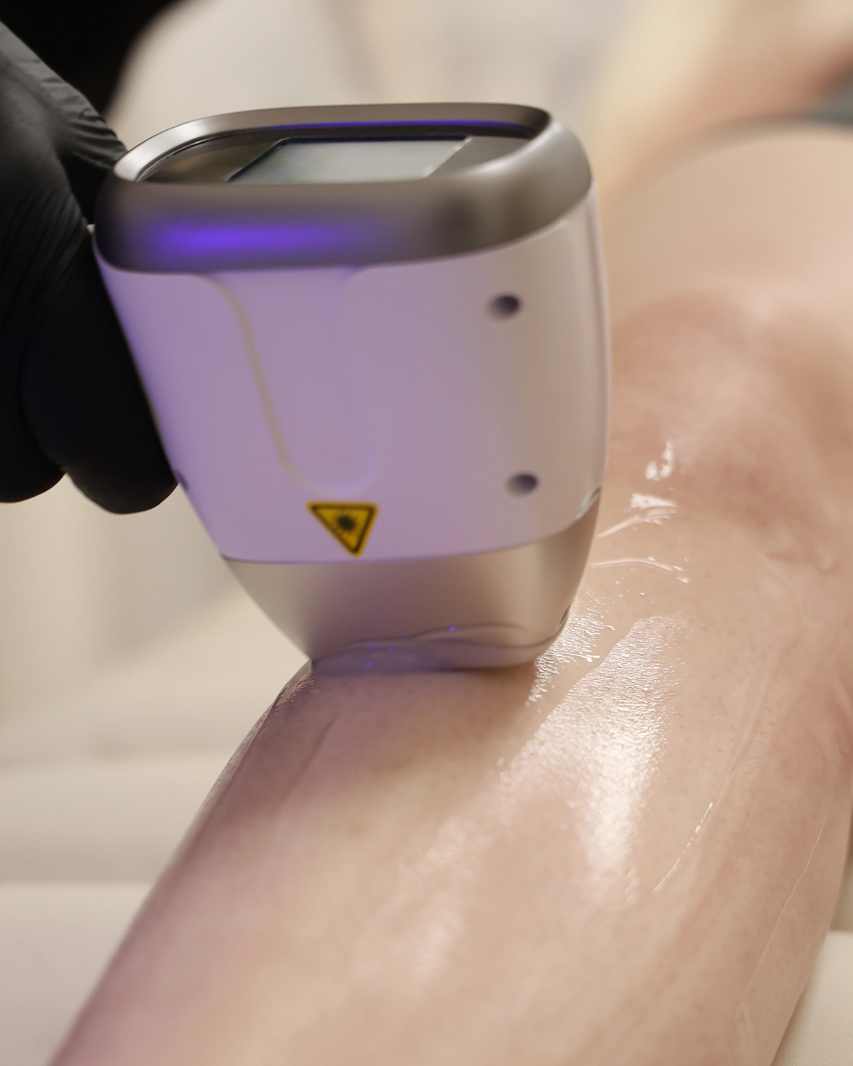Laserska epilacija 4D diodnim laserom u salonu Elena Beauty